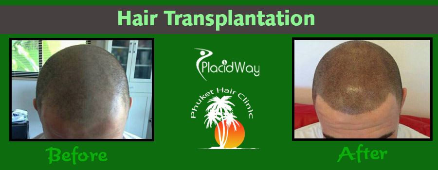 Before and After Hair Transplant Procedure in Thailand