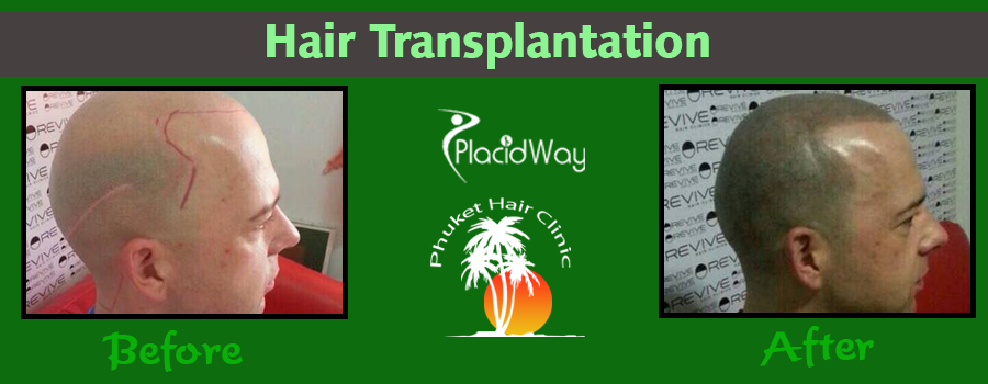 Before and After Hair Restoration in Thailand