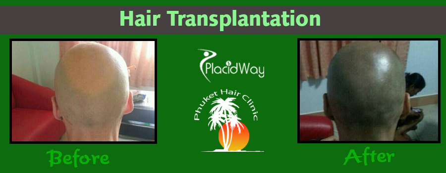 Before and After Patient Testimonial Hair Transplantation Thailand