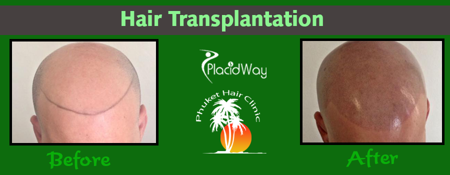 Before and After Hair Replant in Thailand