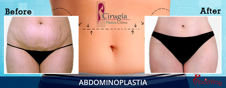 Before and After Abdominoplasty Procedure Mexico