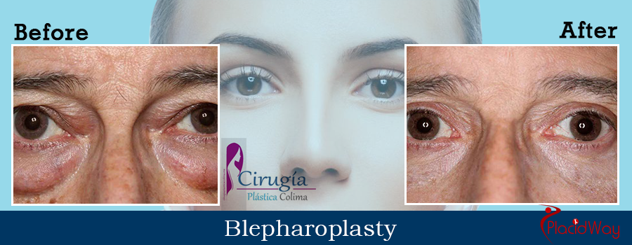 Before and After Blepharosplasty Procedure Mexico