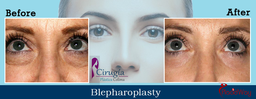 Before and After Patient Testimonial Blepharoplasty in Colima, Mexico