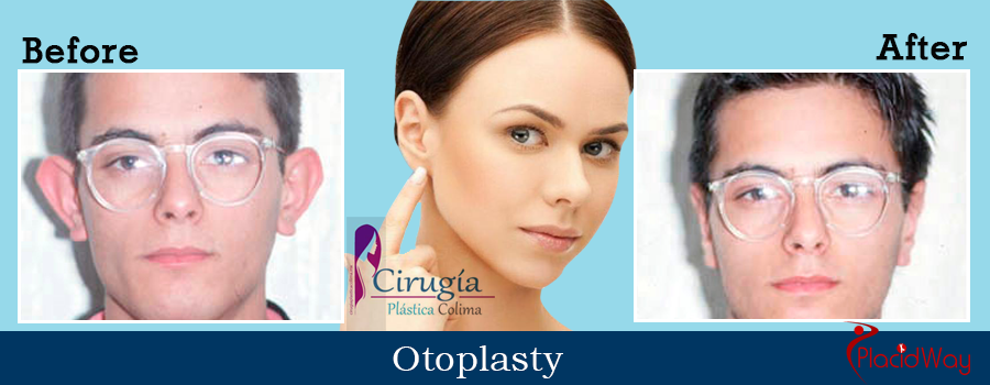 Before and After Otoplasty Procedure Mexico