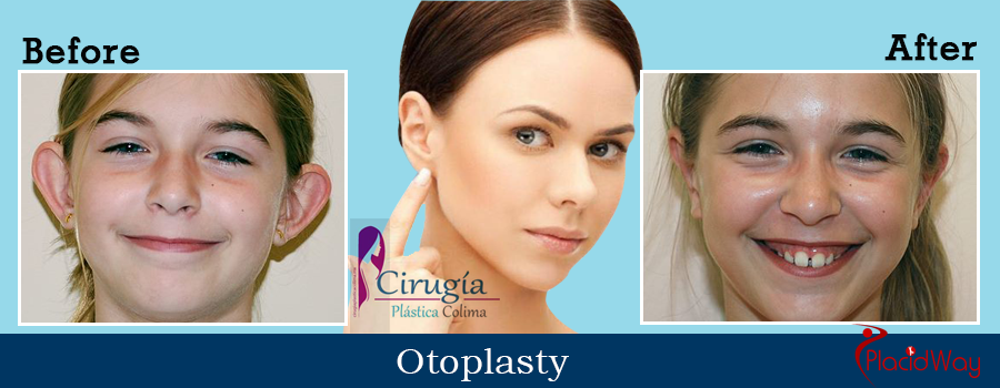 Before and After Patient Testimonial Otoplasty in Colima, Mexico