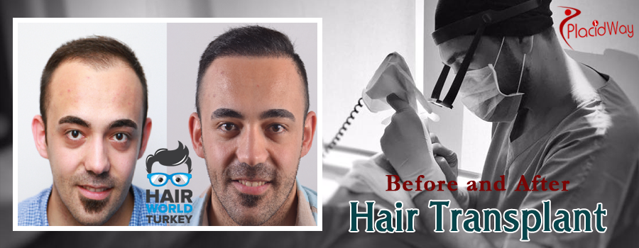 Before and After Hair Transplant Procedure in Turkey