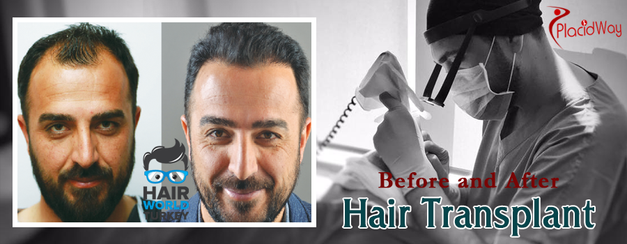 Before and After Pictures of Hair Transplant in Hair World Turkey