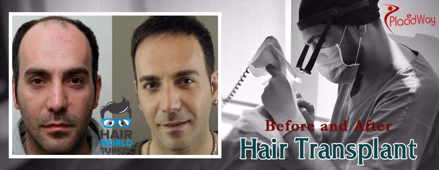 Hair Transplantation Before and After Images Istanbul Turkey
