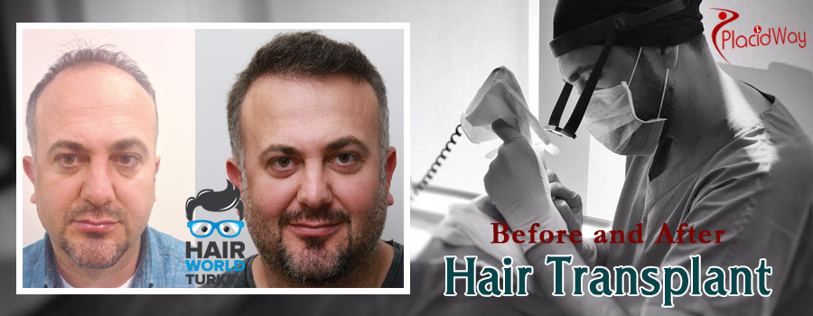 Before and After Hair Restoration in Istanbul, Turkey