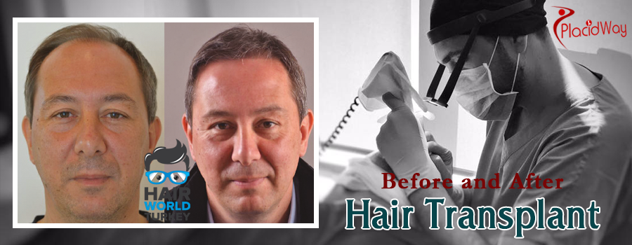 Before and After FUE Hair Transplant Procedure in Turkey