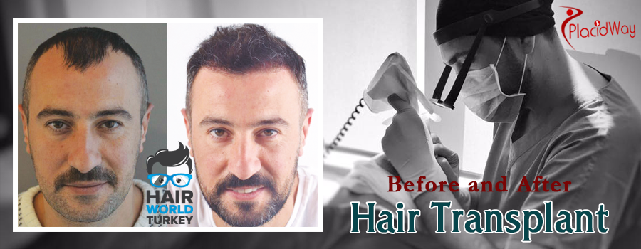 Before and After Hair Transplant in Turkey 