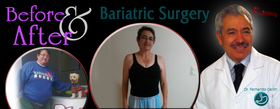 before after bariatric surgery in Mexico men image obesity procedure by Dr. Ceron Cancun, Mexico