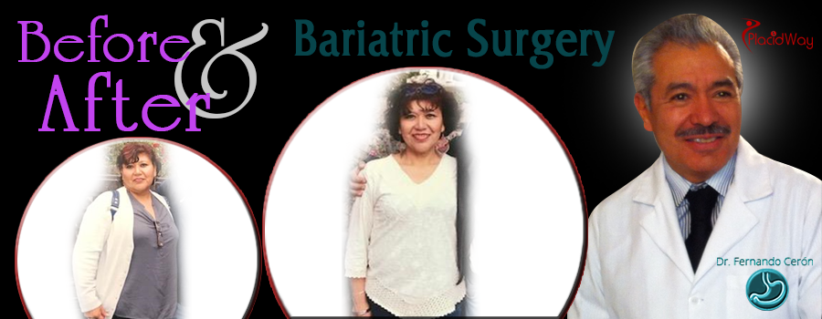 Happy client before and after bariatric surgery in Cancun, Mexico