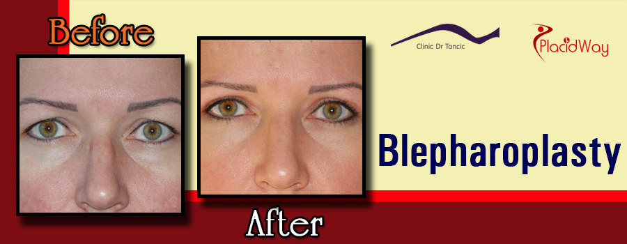 Before and After Blepharoplasty Procedure in Croatia