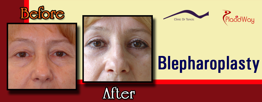 Before and After Blepharoplasty in Zagreb, Croatia