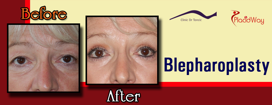 Picture Testimonial Blepharoplasty Surgery Croatia