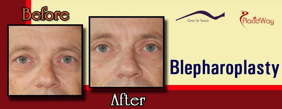 Before and After Blepharoplasty Procedure at Dr. Toncic Clinic, Croatia