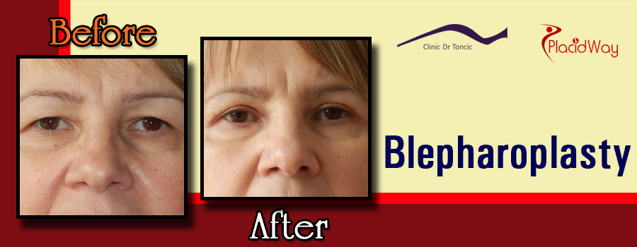 Best results of blepharoplasty surgery in Croatia