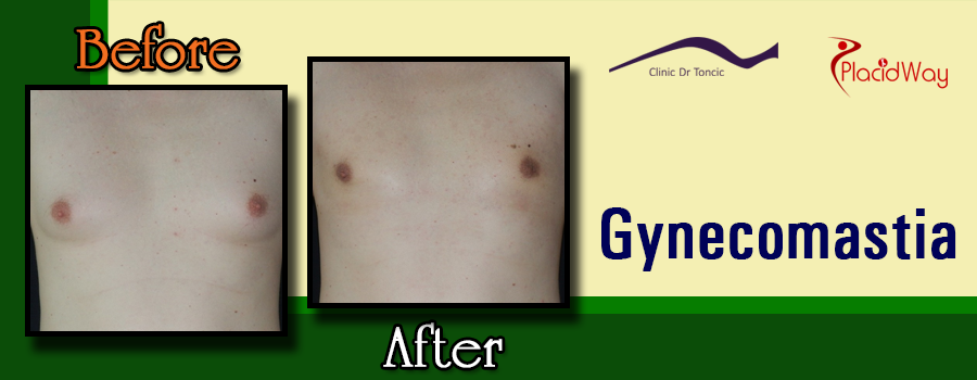 Before and After Gynecomastia in Zagreb, Croatia