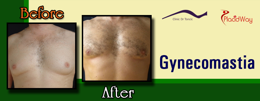 Before and After Gynecomastia Procedure at Dr. Toncic Clinic, Croatia