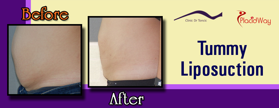 Before and After Tummy Liposuction in Zagreb, Croatia