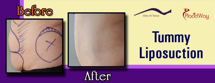 Before and After Tummy Liposuction Procedure at Dr. Toncic Clinic, Croatia