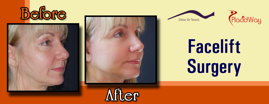 Before and After Facelift Procedure in Croatia