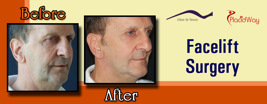 Picture Testimonial Facelift Surgery Croatia