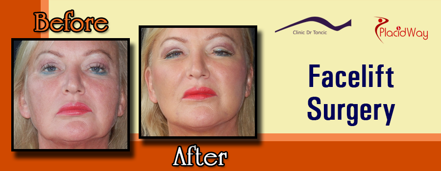 Best results of facelift surgery in Croatia