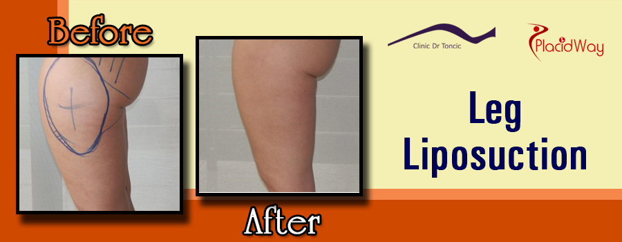 Before and After Leg Liposuction in Zagreb, Croatia