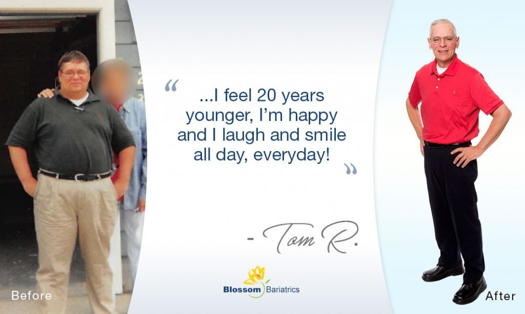 Successful Obesity Surgery Las Vegas Before & After