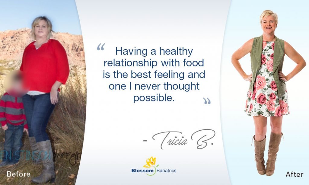 Successful Obesity Surgery Las Vegas Before & After