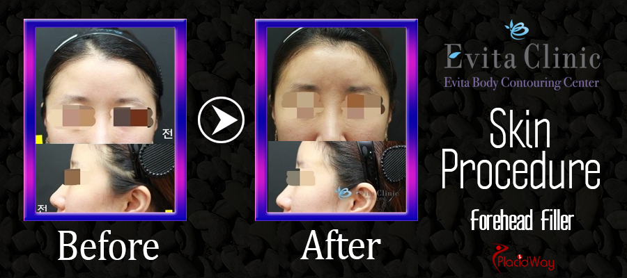 Before and After Images Skin Surgery South Korea