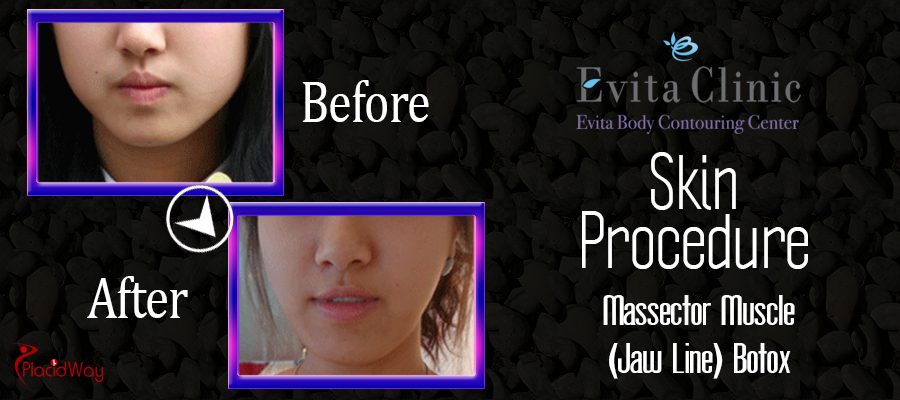 Botox Before and After Evita Clinic South Korea