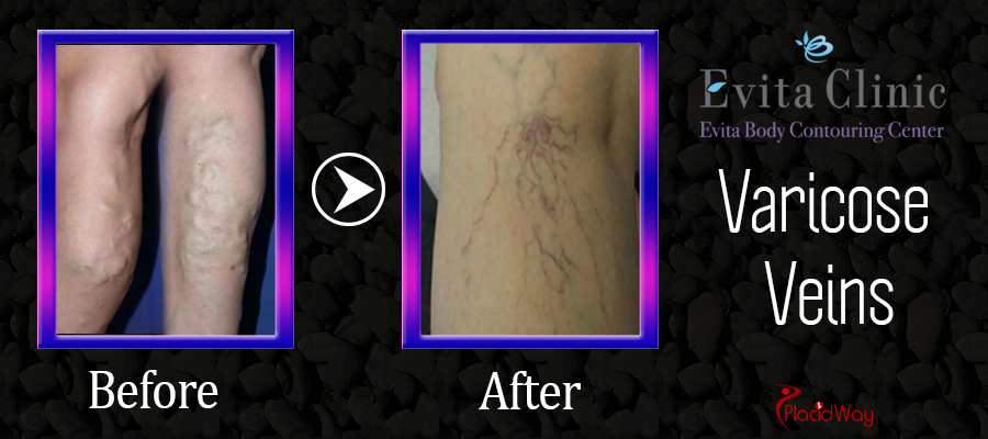 Before and After Images Varicose Veins Surgery South Korea