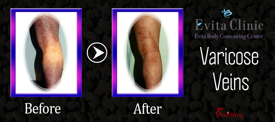 Varicose Veins Surgery Before and After Evita Clinic South Korea