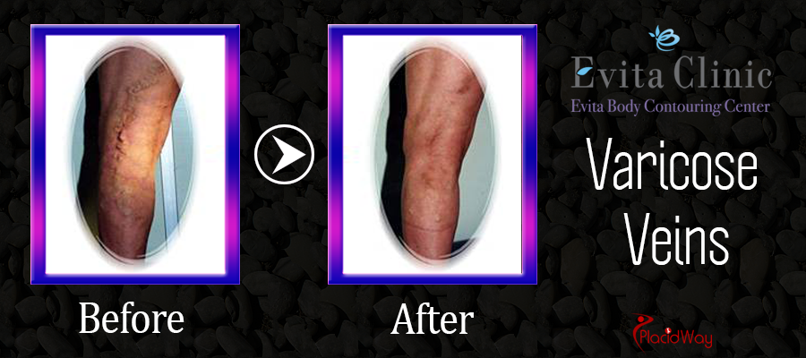 Patient Testimonial Varicose Veins South Korea