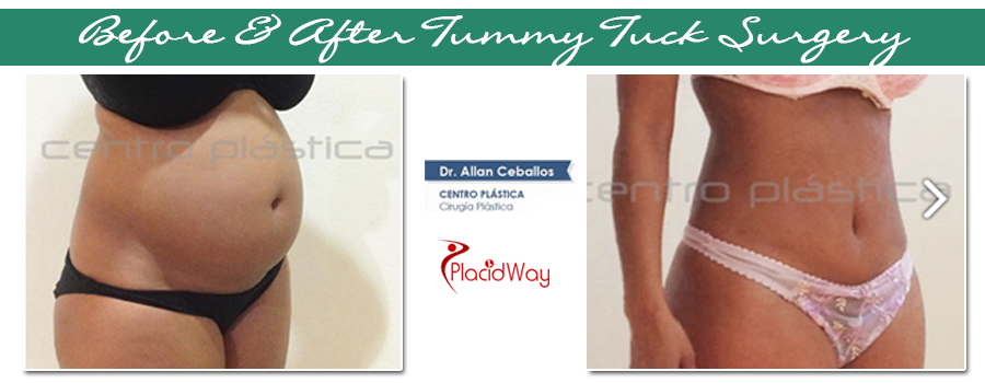 Before and After Cosmetic Surgery in Mexico Before and After Cosmetic Surgery in Mexico