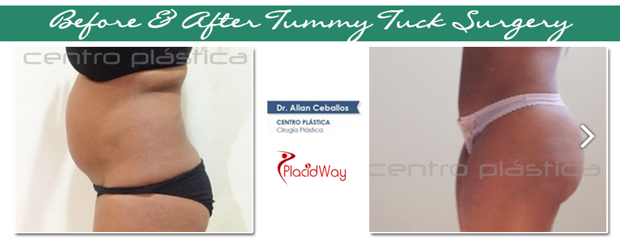 Before and After Tummy Tuck in Latin America Before and After Tummy Tuck in Latin America