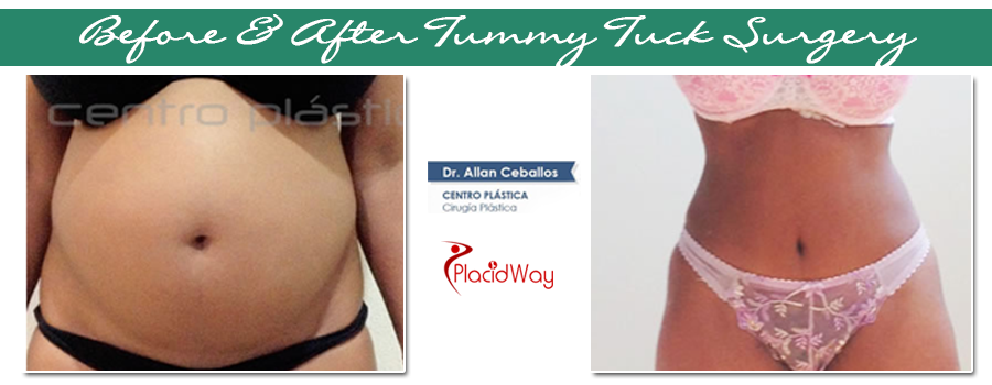 Before & After Tummy Tuck Surgery in Mexico Before & After Tummy Tuck Surgery in Mexico