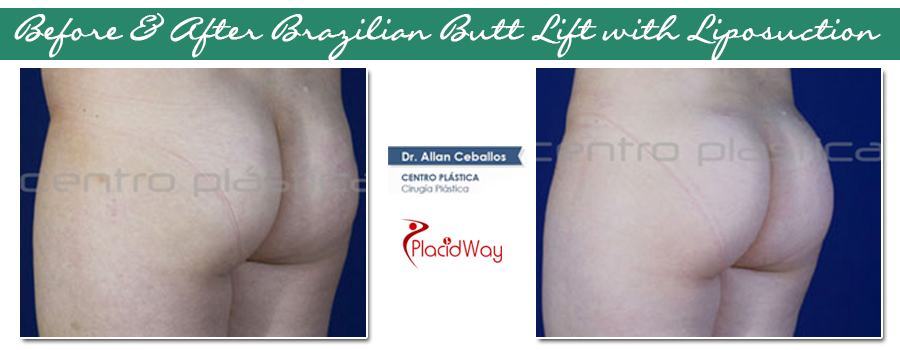 Before and after BBL and 360 Liposuction in Guadalajara, Mexico
