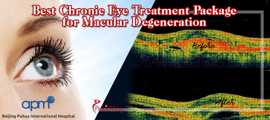 Chronic Eye Treatment Package for Macular Degeneration