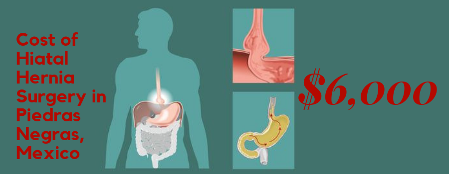 Cost of Hiatal Hernia Surgery in Piedras Negras, Mexico