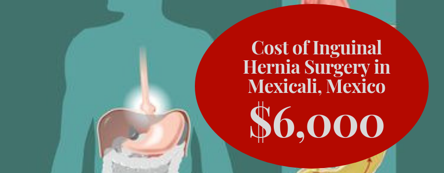 Cost Inguinal Hernia Surgery in Mexicali, Mexico