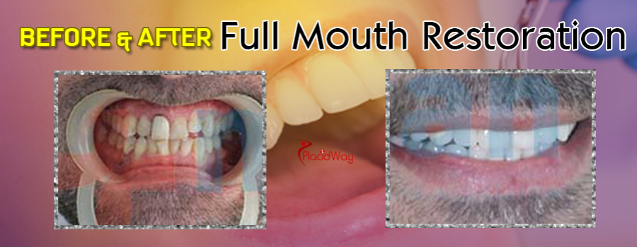 Before and After Full Mouth Restoration Packages in Mexico