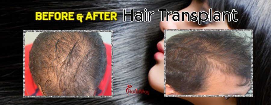 Before and After Hair Transplant Packages in Mexico