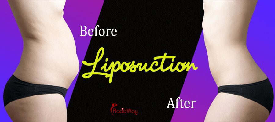 Before and After Liposuction Surgery