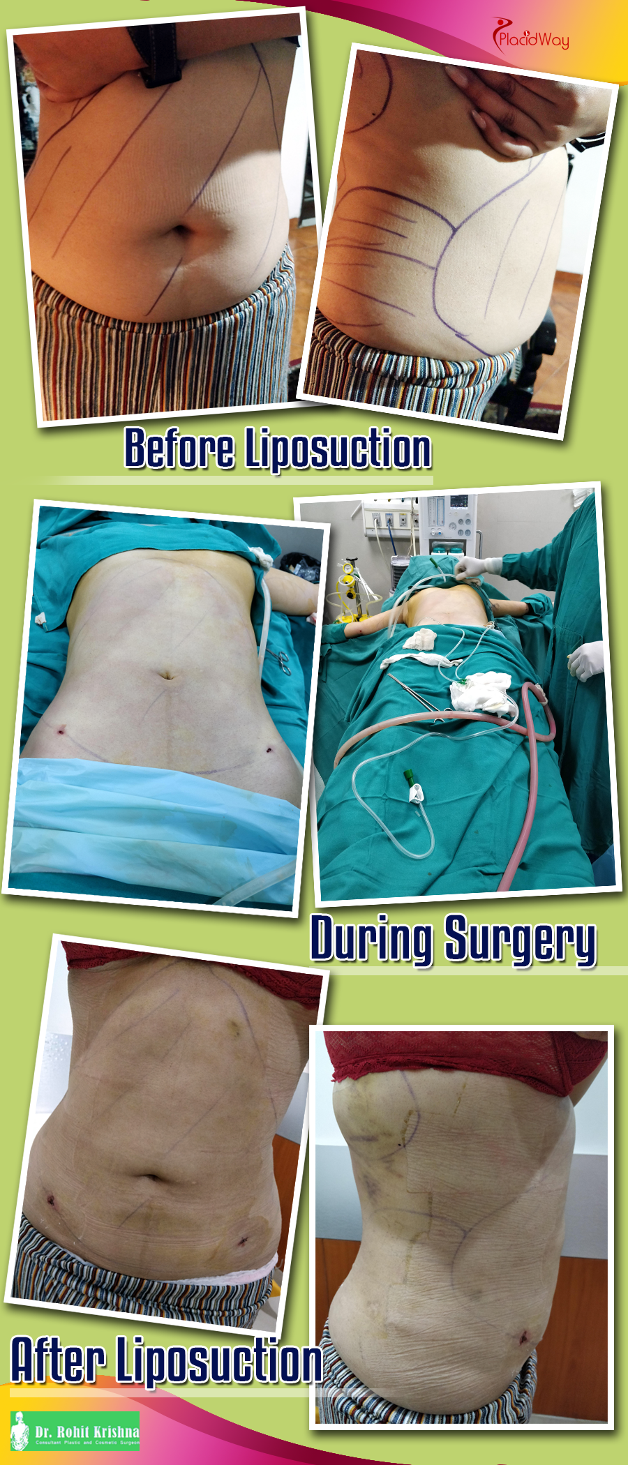 Patient Testimonial after Liposuction Surgery in India