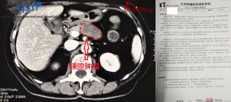 HIFU Treatment for Pancreas Cancer at BPIH