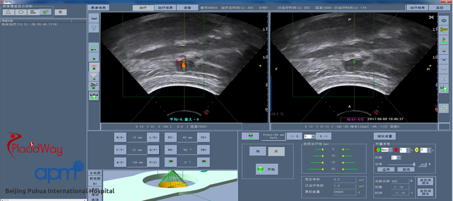 HIFU Treatment for Pancreas Cancer at BPIH